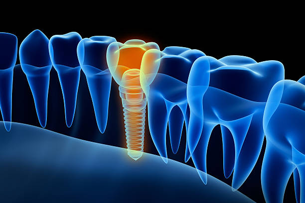 Comprehensive Implant Solutions