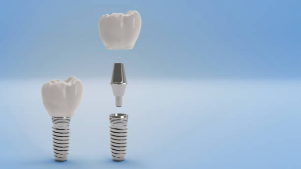 Zirconia and Titanium Abutment Package